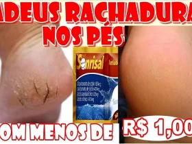 como acabar com as rachaduras dos pés