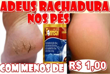 como acabar com as rachaduras dos pés