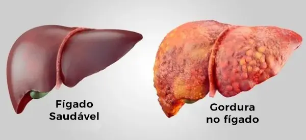 Sinais de Gordura no Fígado: Descubra Agora!