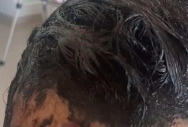 veja um jeito pratico e facil de como tirar tinta de cabelo da pele