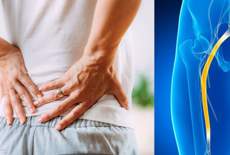 aliviar a dor ciática