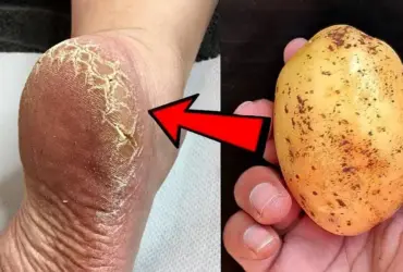como acabar com rachaduras dos pés