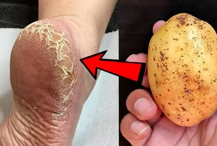 como acabar com rachaduras dos pés