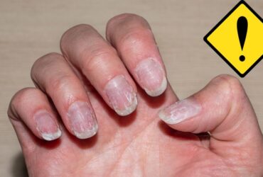 linhas finas nas unhas