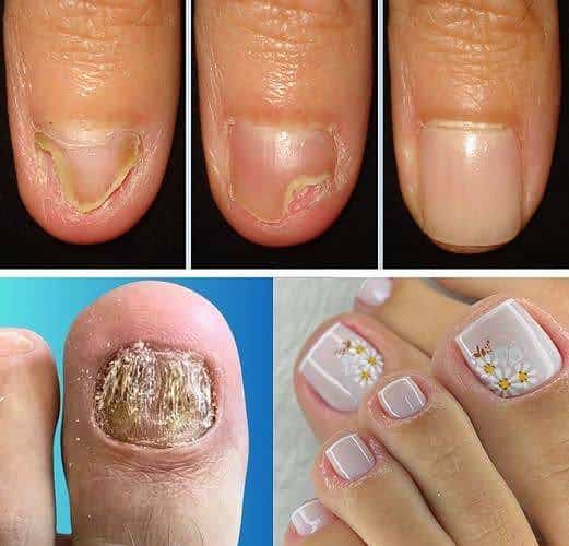micose de unha