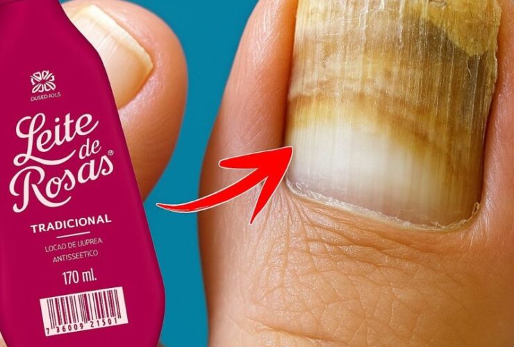 micose de unha com leite de rosas