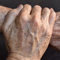 Remova Manchas de Idade Naturalmente: Receita Caseira otimizada