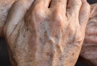 remover manchas de idade naturalmente
