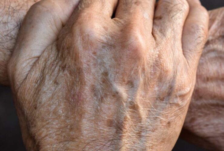 remover manchas de idade naturalmente