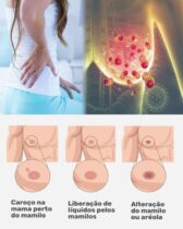 Sintomas do câncer de mama: conheça os 6 essenciais