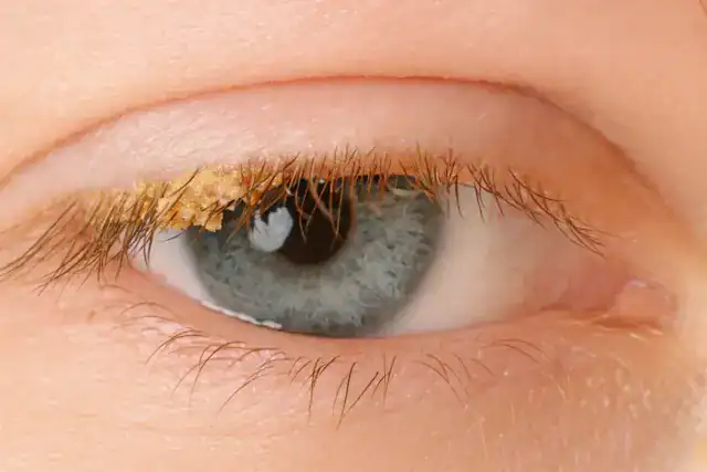 Ter Este Tipo Sanguíneo Pode Te Fazer Envelhecer Mais Devagar 3 Crosta Amarela nos Olhos: Causas, Cuidados e Quando se Preocupar