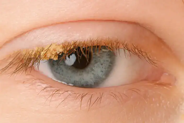 Exemplo de crosta amarela nos olhos ao acordar