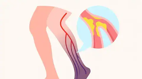 Ilustração mostrando coágulo sanguíneo na perna, com veia obstruída, indicando trombose venosa profunda
