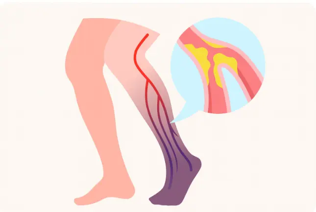 Ilustração mostrando coágulo sanguíneo na perna, com veia obstruída, indicando trombose venosa profunda