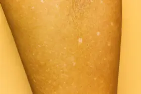 Manchas Brancas na Pele: O Que Seu Corpo Está Tentando Avisar