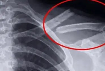 bebidas q destroi os ossos