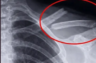 bebidas q destroi os ossos